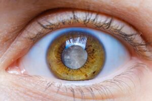 Cataract Surgery