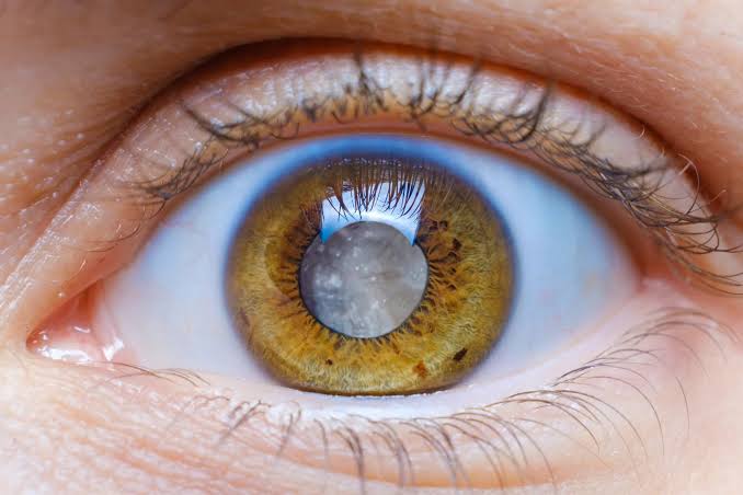 Cataract Surgery