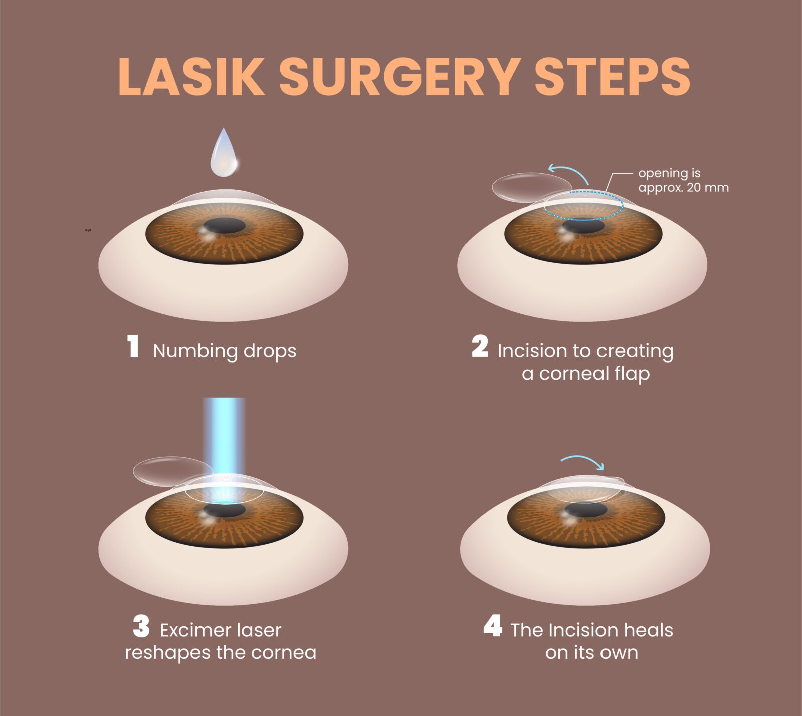 What to Expect Before, During and After LASIK